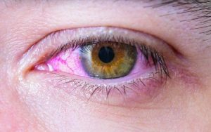 Les yeux rouges